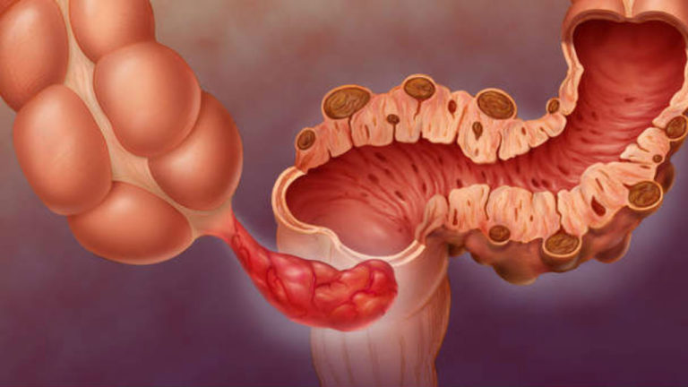 Diverticulite O Que Causas Sintomas Tratamento Tem Cura