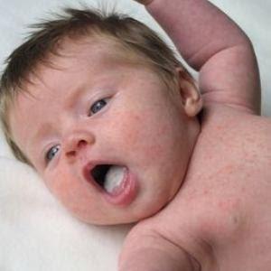 Bebê com língua parasitada por fungos deuteromicetos