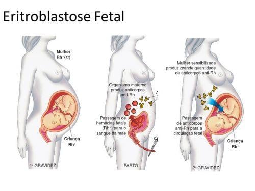 Eritroblastose fetal ou doença hemolítica do recém-nascido