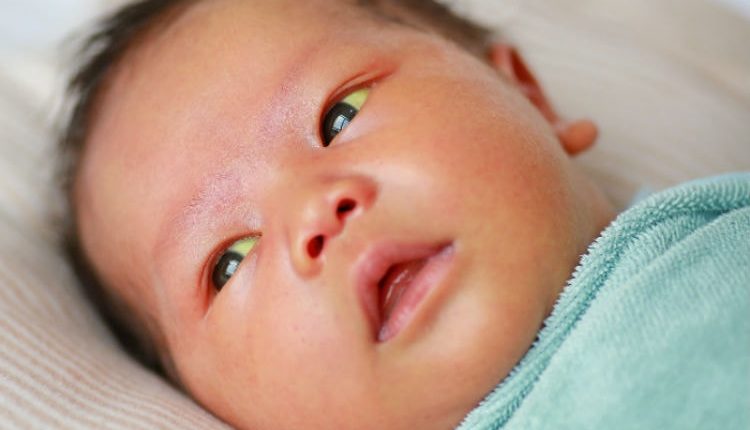 Why Newborn Eyes Are Yellow