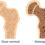 Osteoporose