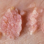 HPV – Sintomas