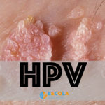 HPV – Vírus do Papiloma Humano