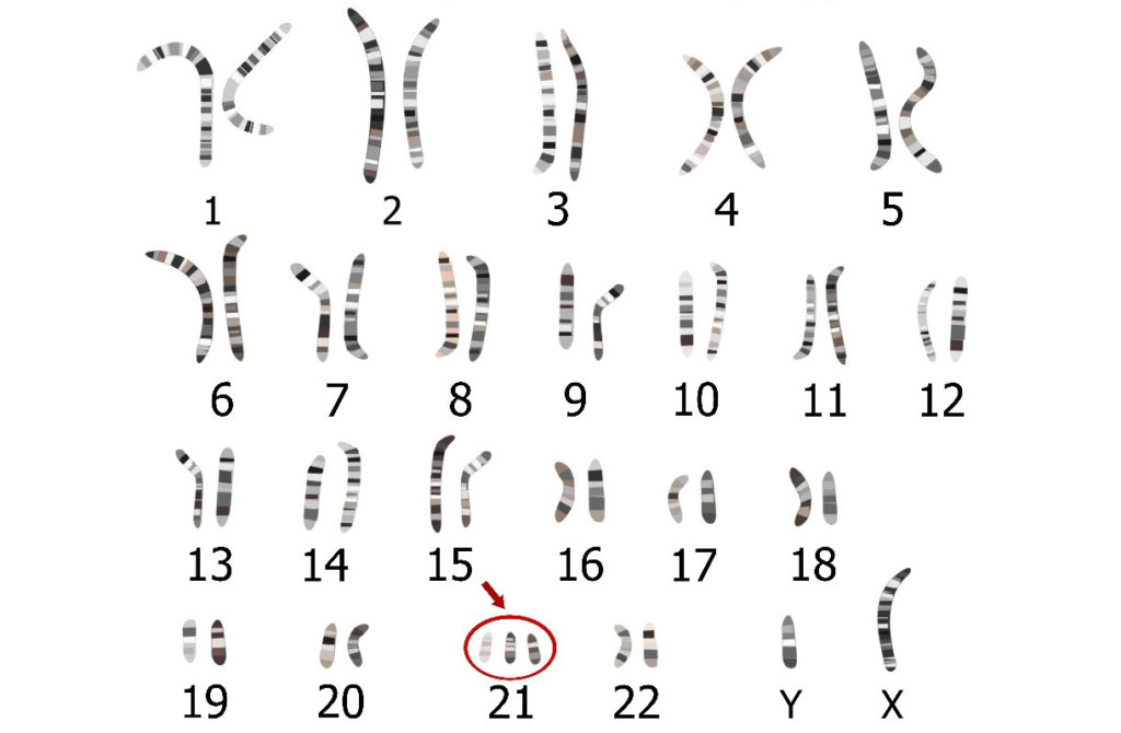 Cromossomos - Cariótipo da Trissomia 21