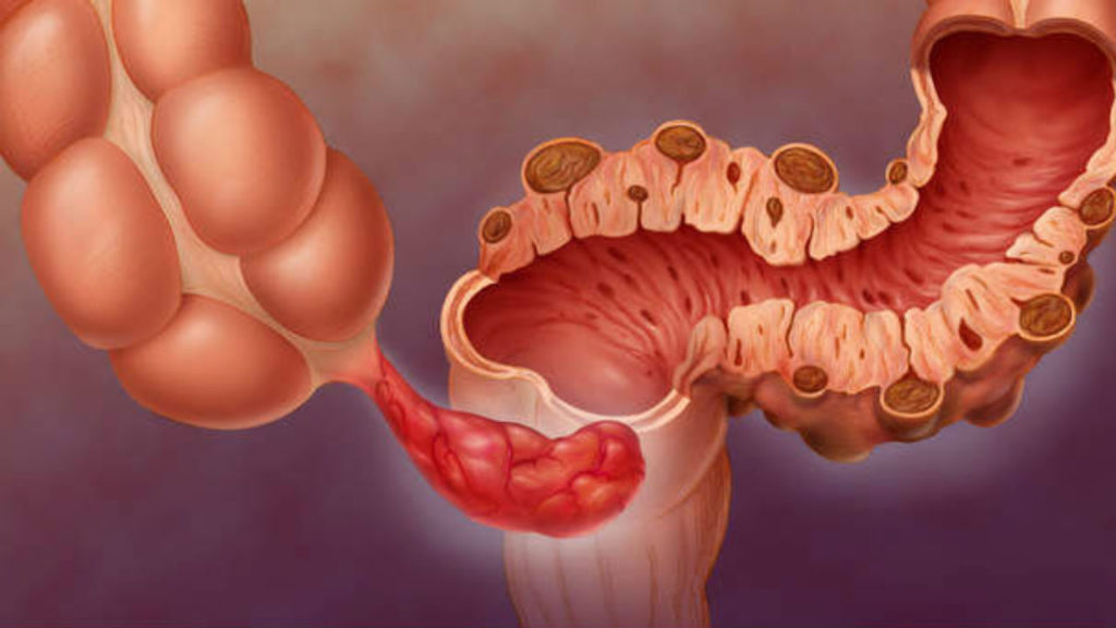 Diverticulite - Pequenas bolsas nas paredes do intestino
