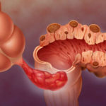 Diverticulite – Pequenas bolsas nas paredes do intestino