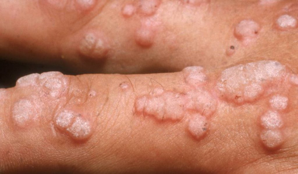 HPV - Sintomas