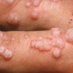 HPV – Sintomas