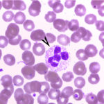 Neutrófilo (seta preta) com núcleo segmentado. (Foto retirada do site do Laboratório de Análises Clínicas e Ensino em Saúde  – LACEN – da UFG).