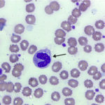 Neutrófilo (seta preta) com núcleo em bastão. (Foto retirada do site do Laboratório de Análises Clínicas e Ensino em Saúde  – LACEN – da UFG).