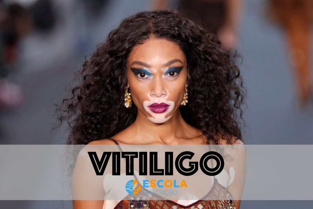 Vitiligo - Modelo canadense Winnie Harlow