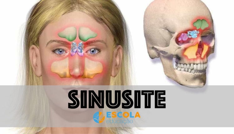 Sinusite - Resumo, O Que é, Sintomas, Tratamento, Prevenção, Cura