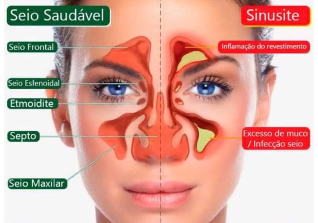 Sinusite - Inflamação nos seios da face