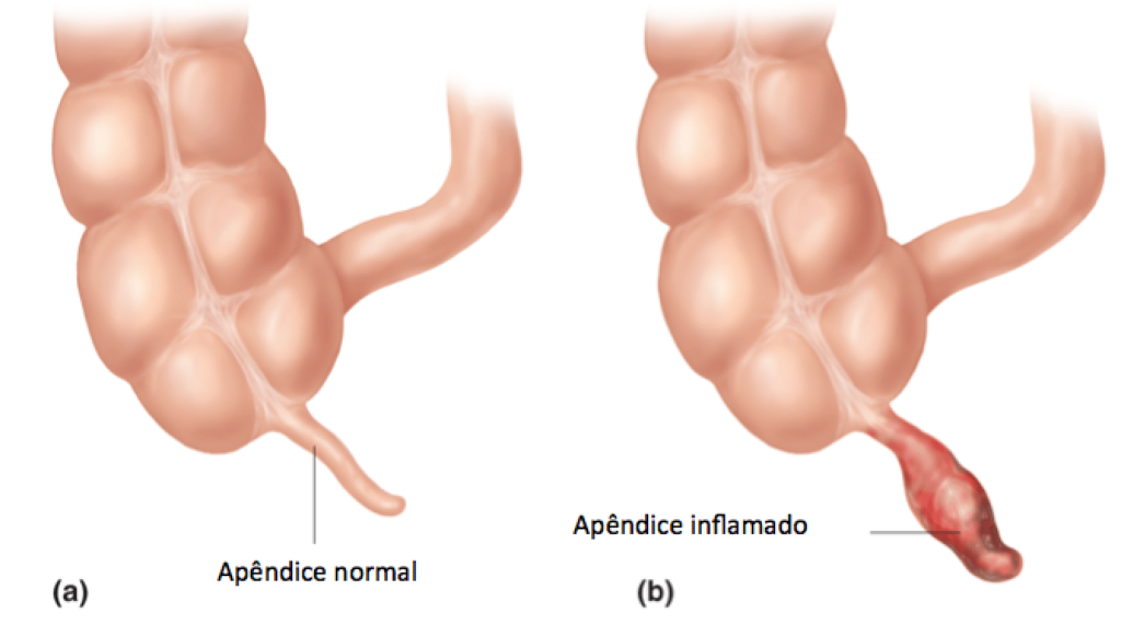 Apendicite aguda - Apêndice normal em (a) e apêndice inflamado em (b).