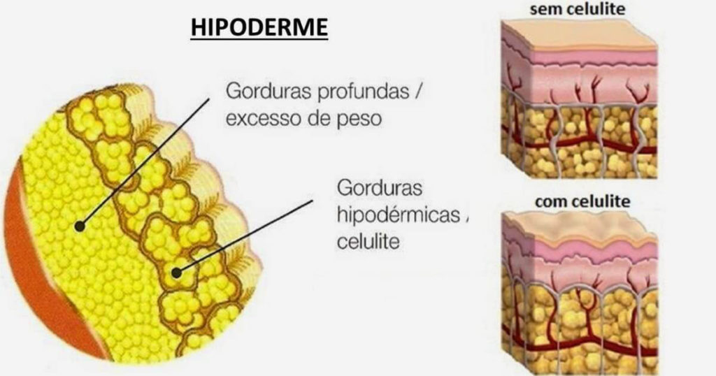 Hipoderme - Formação da celulite