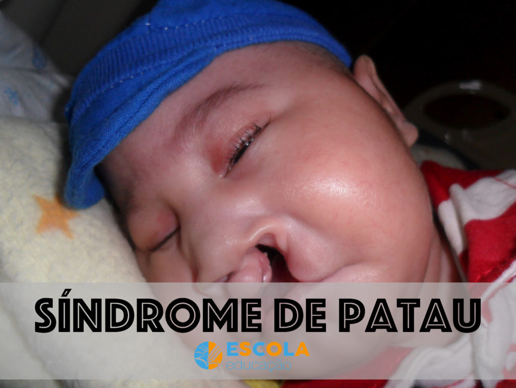 Síndrome de Patau