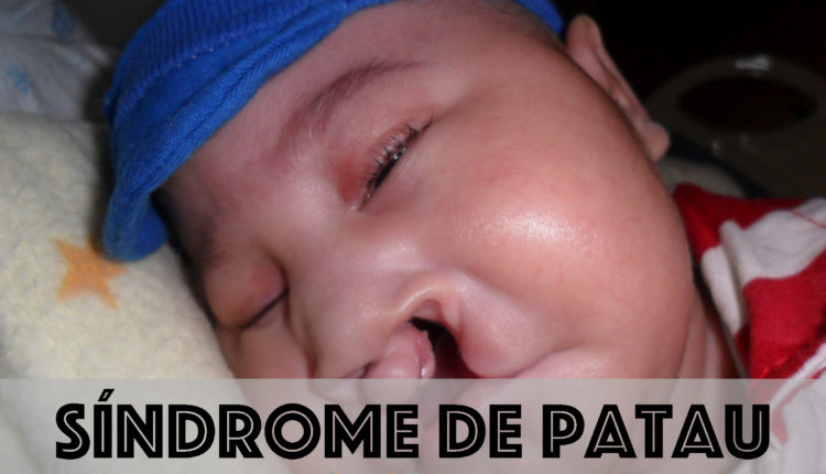 Síndrome de Patau - O que é, sintomas, diagnóstico, tratamento