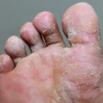 Micose