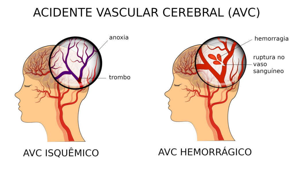Acidente Vascular Cerebral - AVC