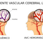 Acidente Vascular Cerebral – AVC