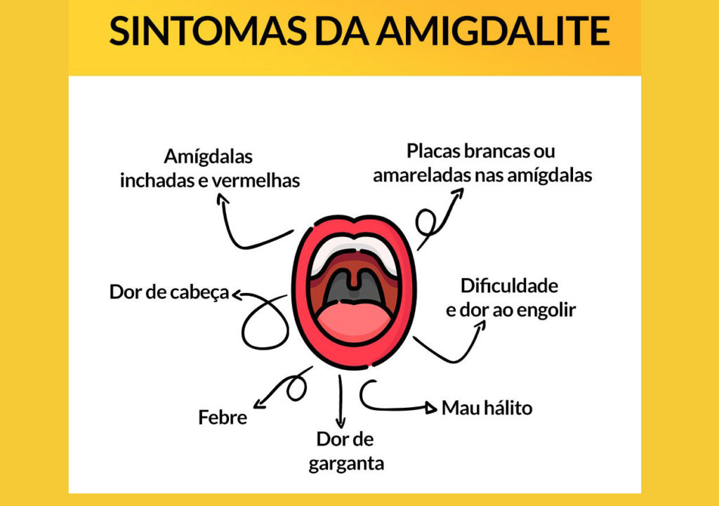 Sintomas da amigdalite