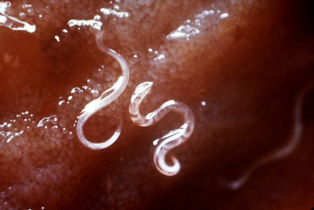 Ancilostomose