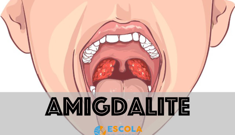 Amigdalite