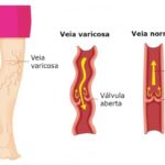Veias do corpo humano – Varizes