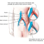 Veias do corpo humano – Veia ilíaca