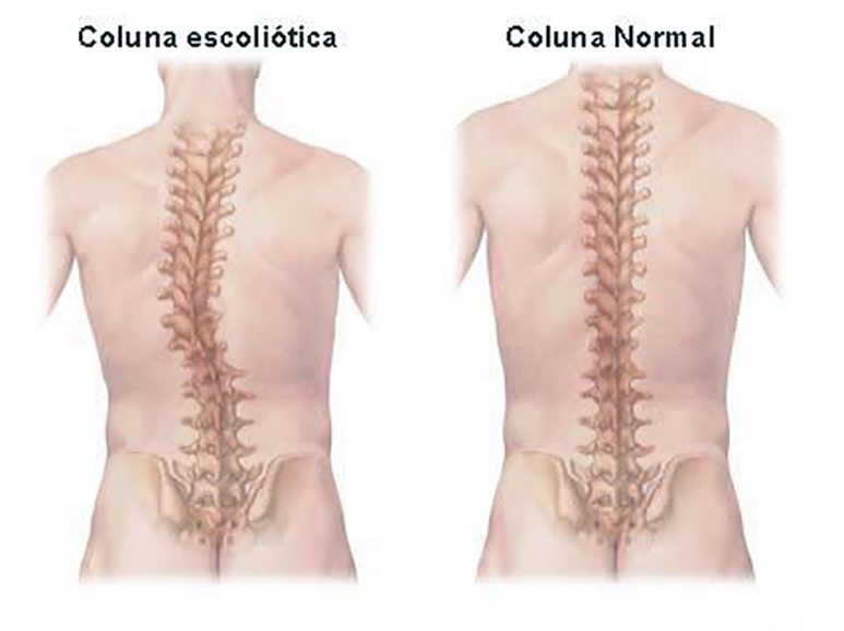Doenças da coluna vertebral