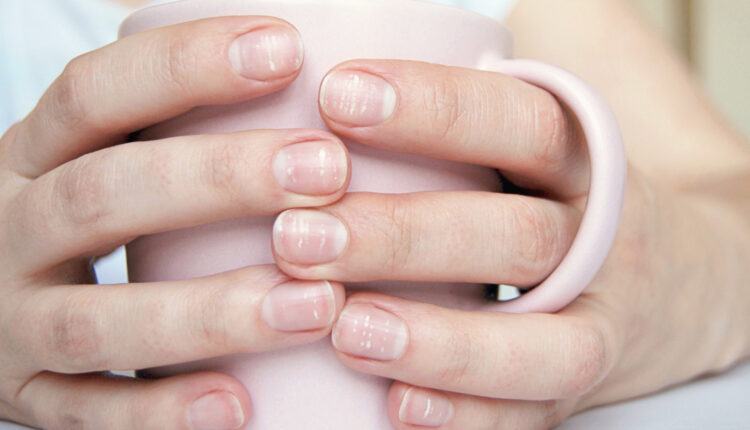 Suas unhas podem ajudar a identificar doenças.