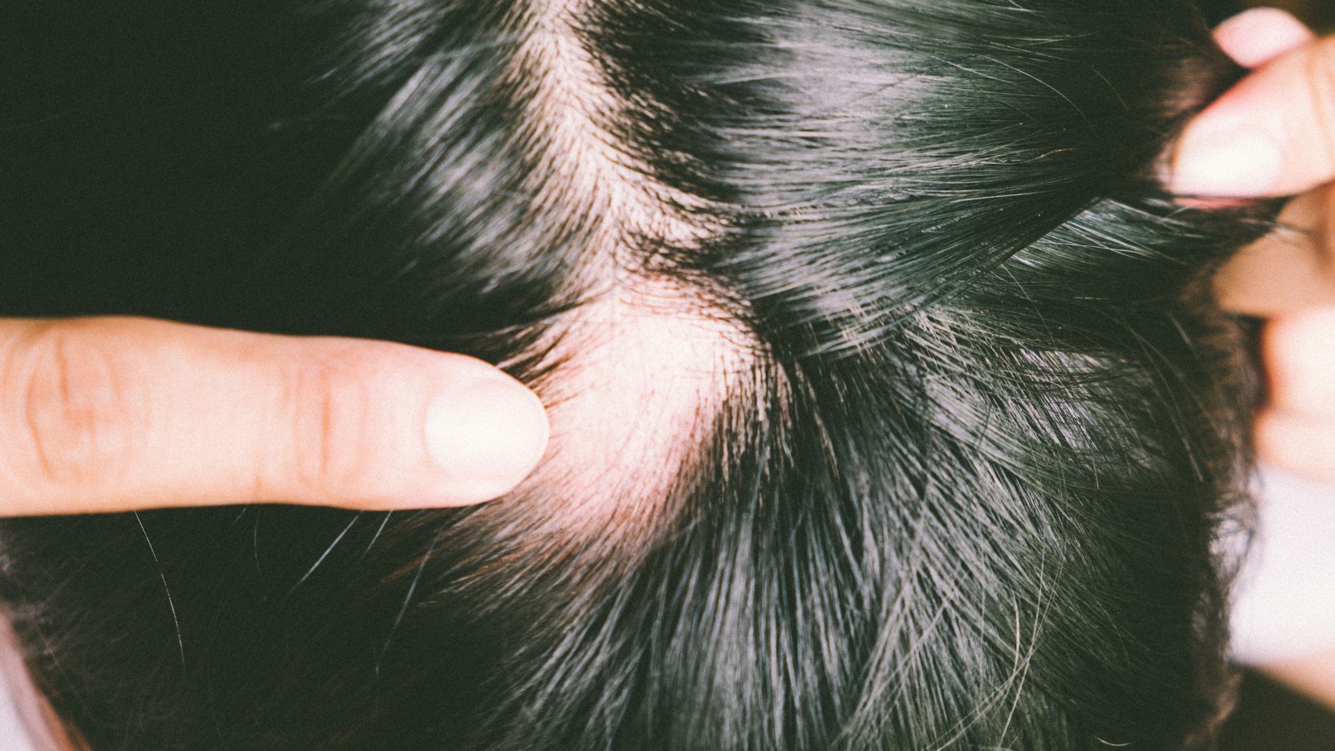 Tratamento oral para alopecia