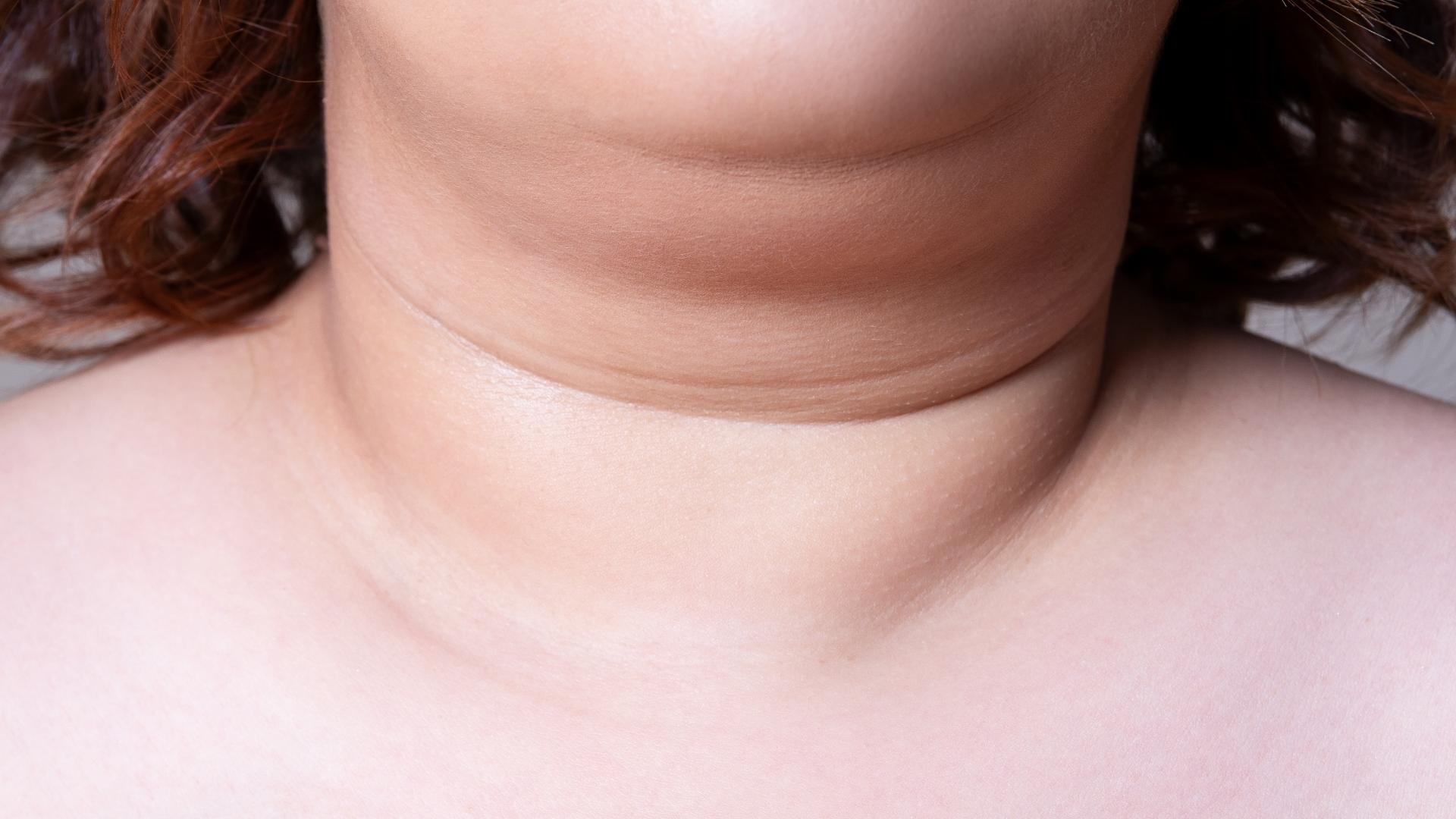Como se livrar da gordura do pescoço de uma vez por todas?