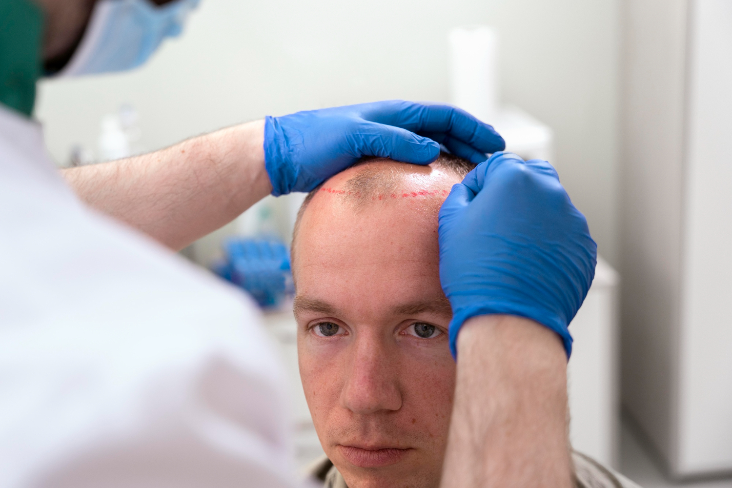 Transplante de cabelo vale a pena? Conheça alternativa para perda capilar