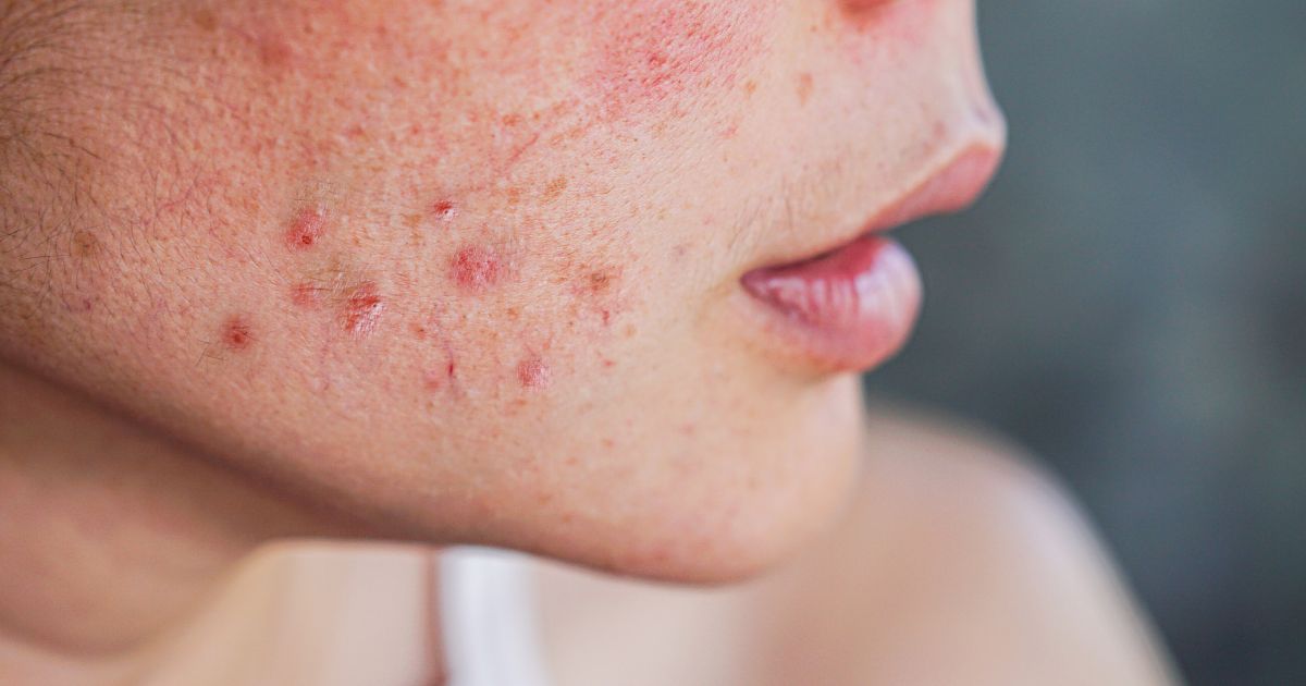 Quais alimentos podem agravar a acne? Entenda como a dieta influencia pele